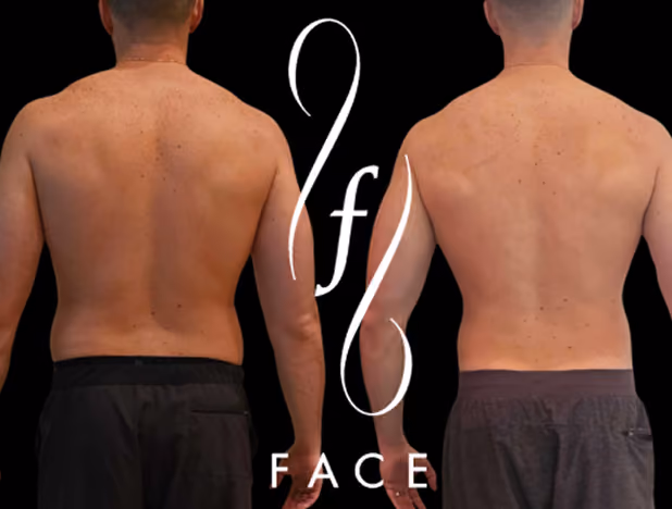 Comparison of a man's back before and after physical transformation, showing reduced body fat and improved muscle tone.
