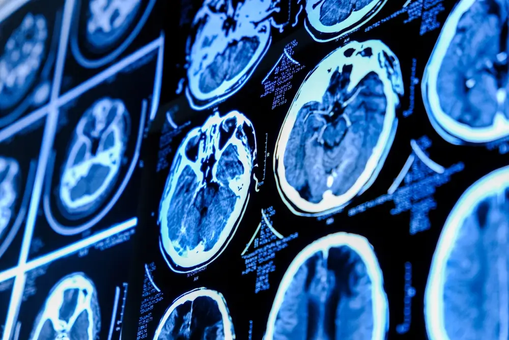 MRI images