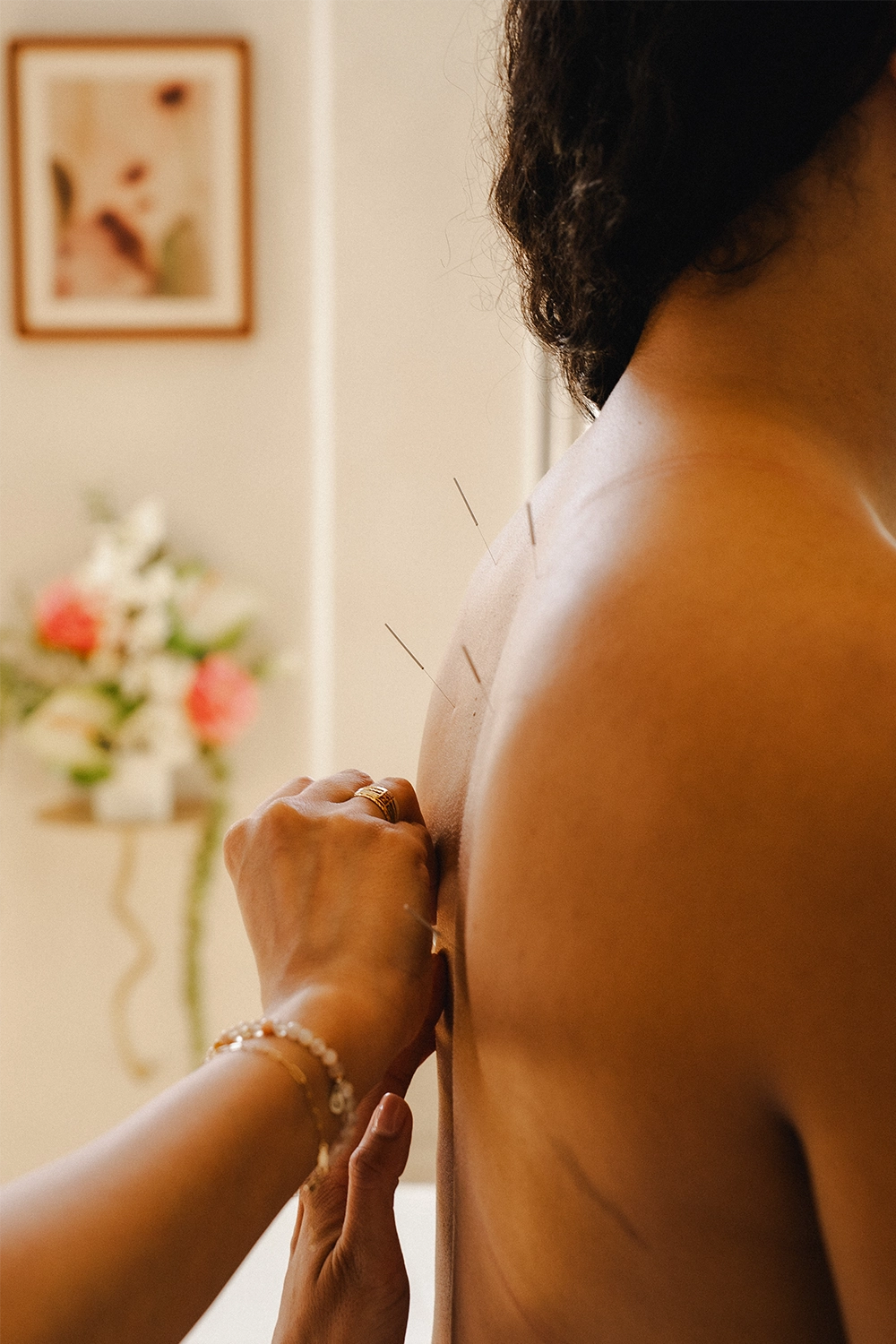 woman getting acupunctures