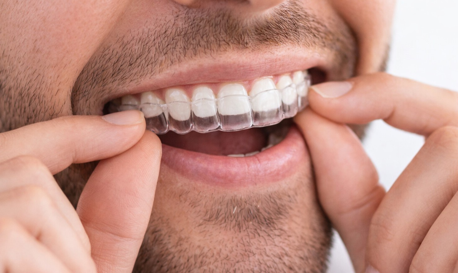 Clear dental retainers used to maintain teeth alignment after orthodontic treatment