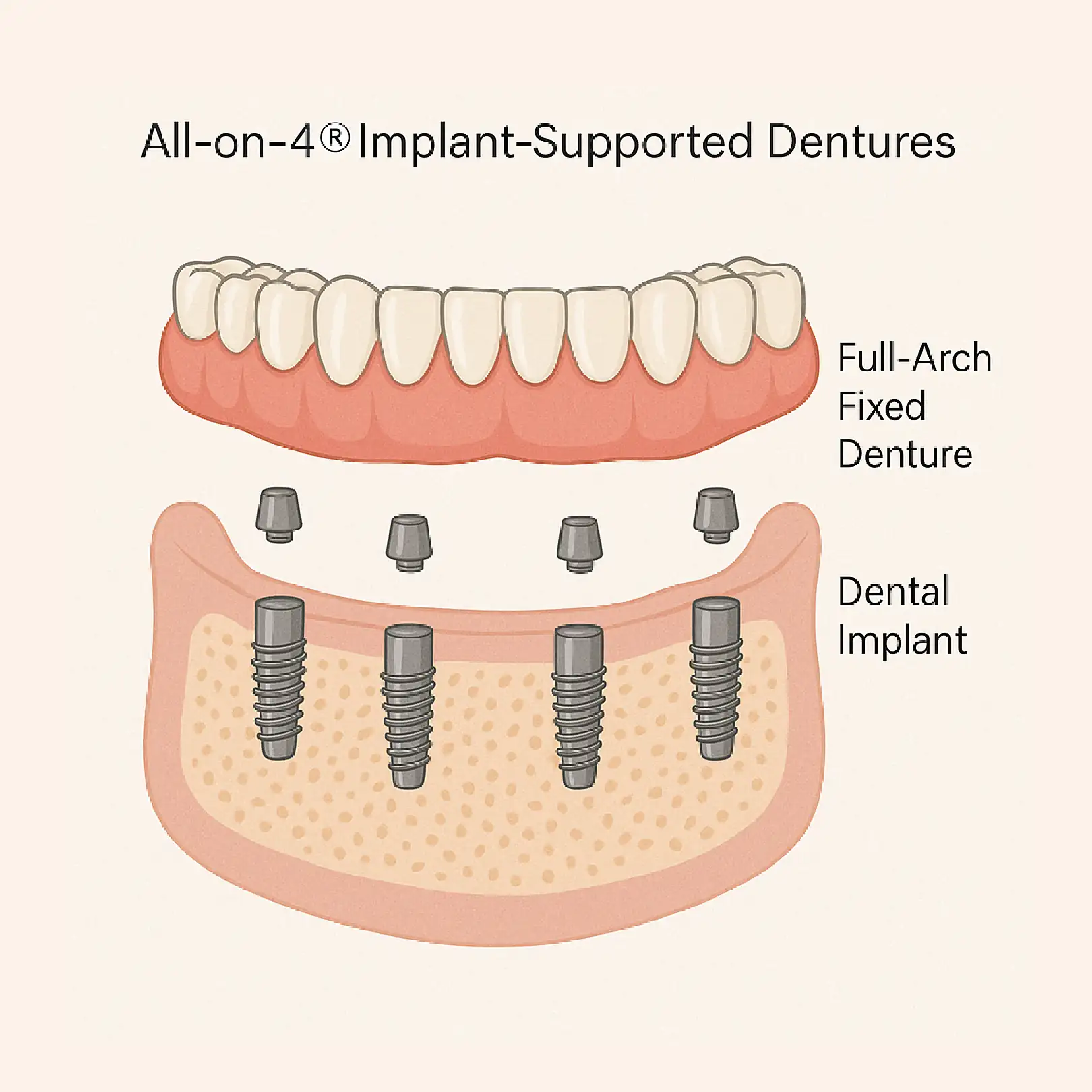 Graphic of All-On-4s dental implants