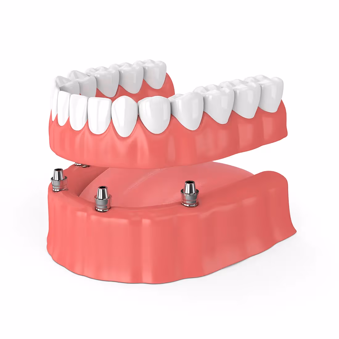 Implant-Retained Dentures