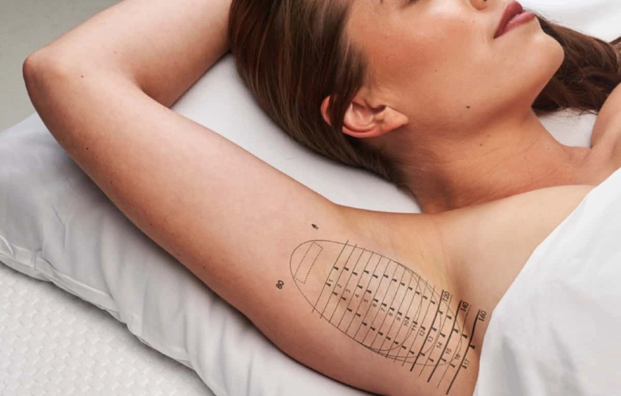 Woman lying down with treatment grid marked on underarm for miraDry procedure to reduce sweating