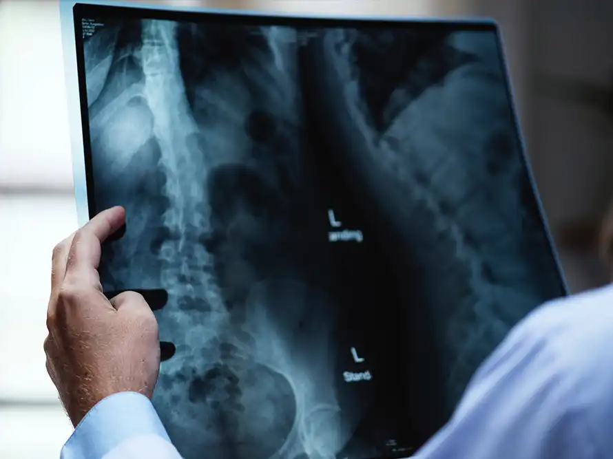 Person holding a spinal X-ray image showing vertebrae and pelvis.