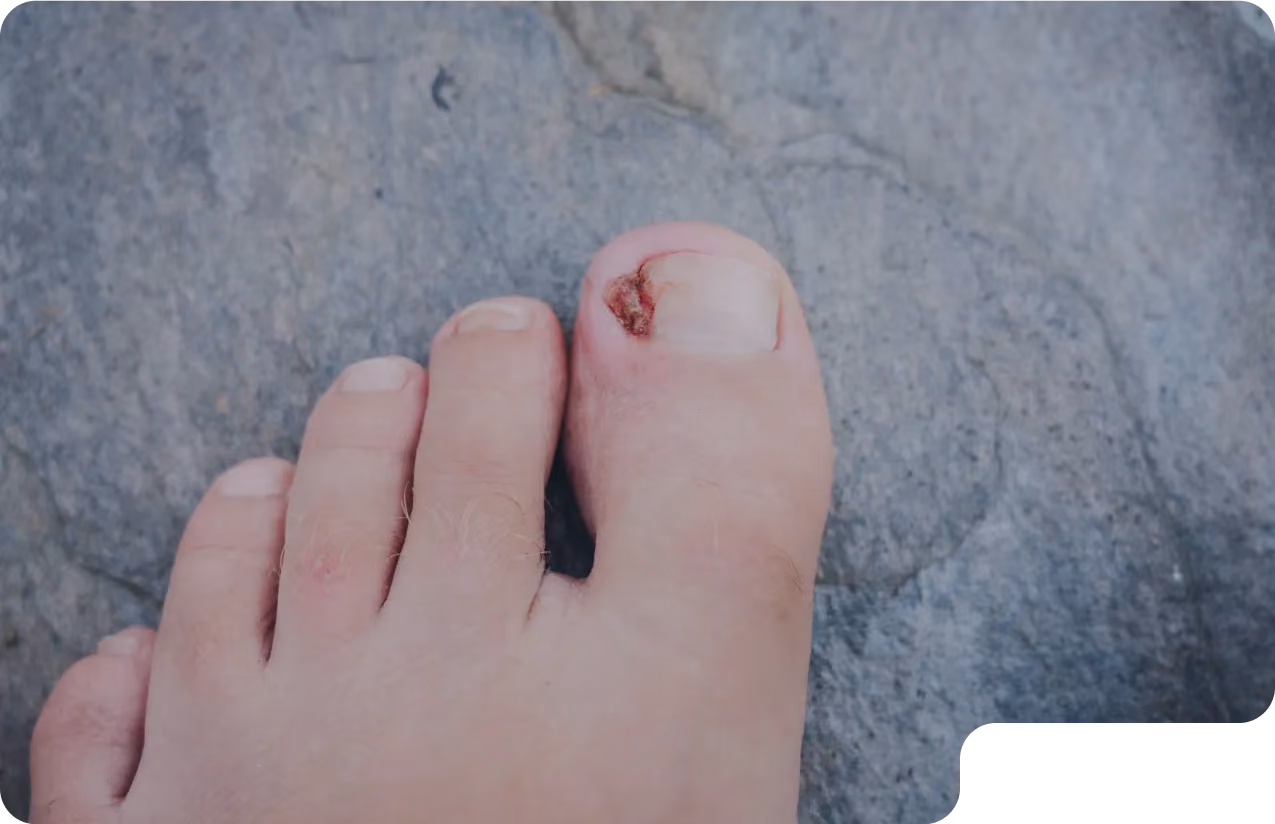 Foot with infected toenail on gray background. Patient needs foot doctor in Beverly Hills.