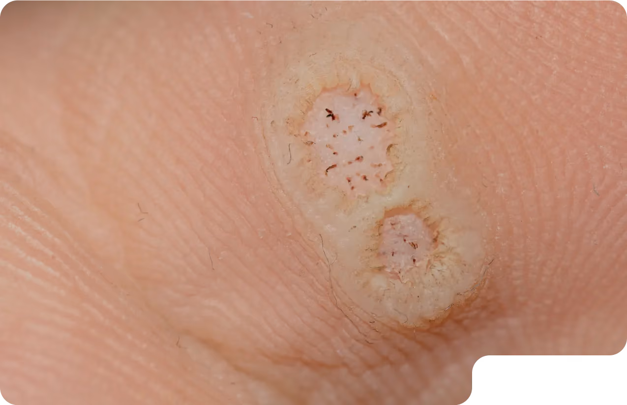Wart on the bottom of foot in Beverly Hills