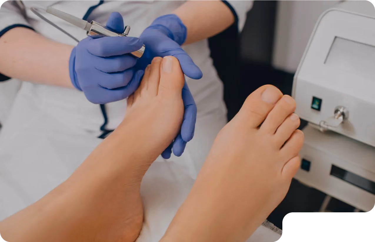Woman receives laser treatment for toenail fungus in Beverly Hills