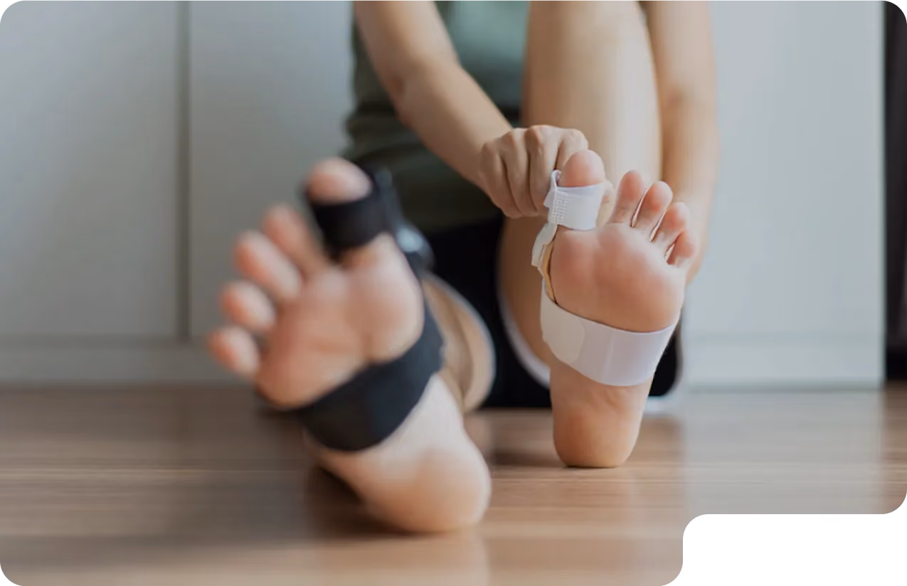 Closeup of a woman’s foot with a developing bunion in need of the best bunion treatment in Beverly Hills