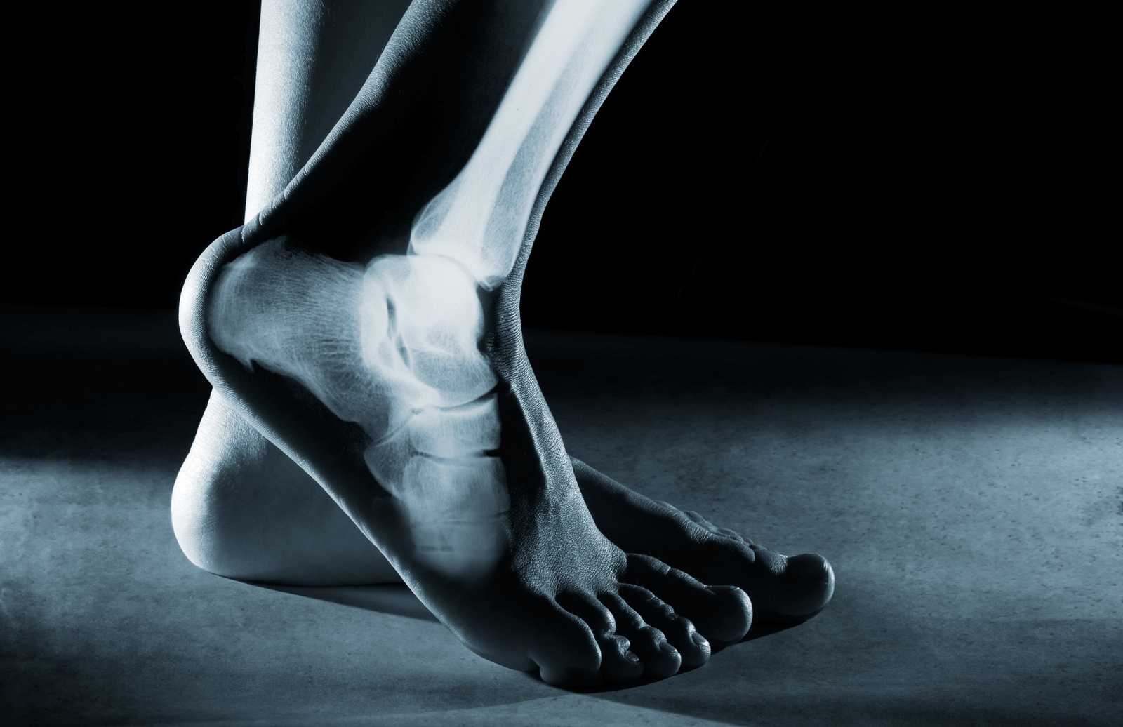 X-ray style image of an ankle and foot showing joint structure and damage, illustrating regenerative medicine to heal ankle injuries and care from the best podiatrist in Los Angeles.