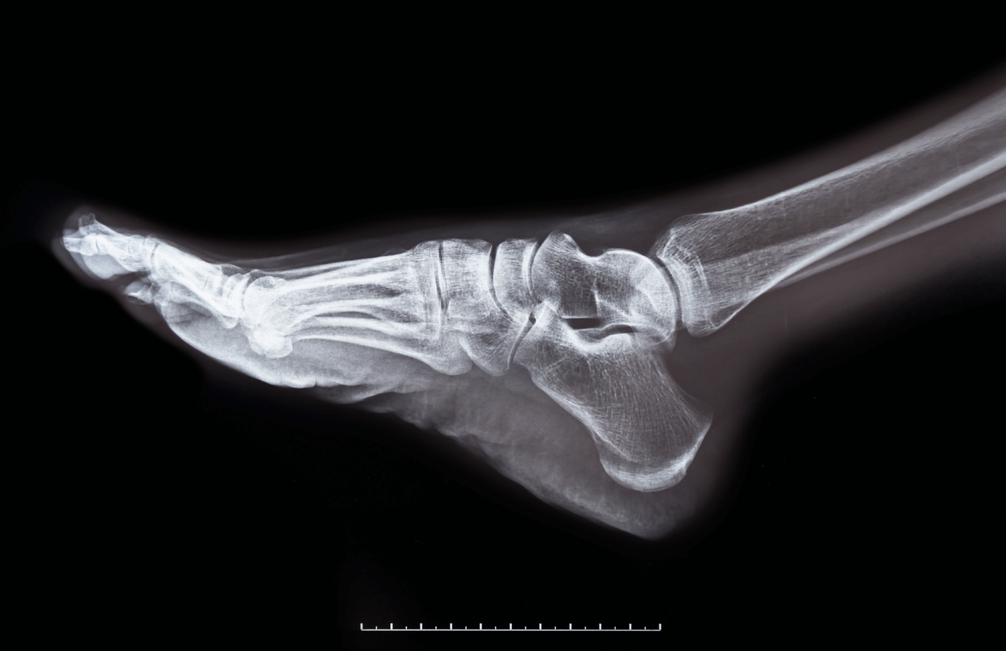 Foot fracture X-ray showing broken bones in the foot, highlighting diagnosis and treatment options from the best foot doctor in Los Angeles.