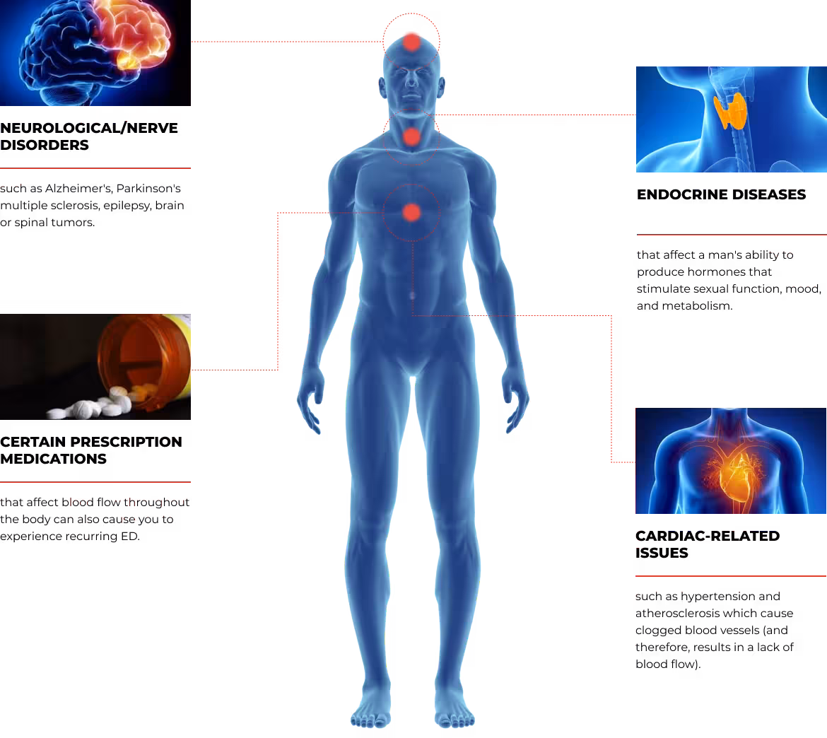 Anatomical diagram illustrating the physiological causes of ED and the therapeutic role of shockwave therapy