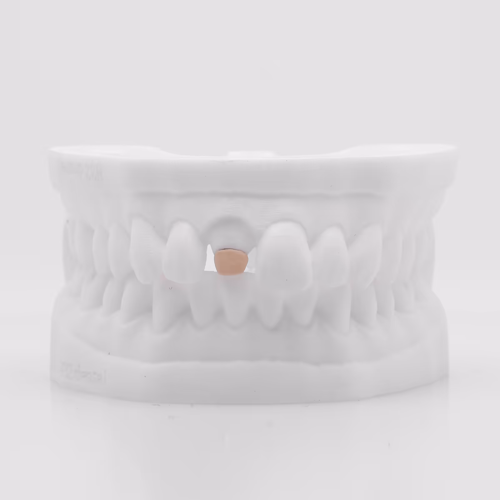 Inlay Core titane céramisé pour reconstitution esthétique - H32 Dental