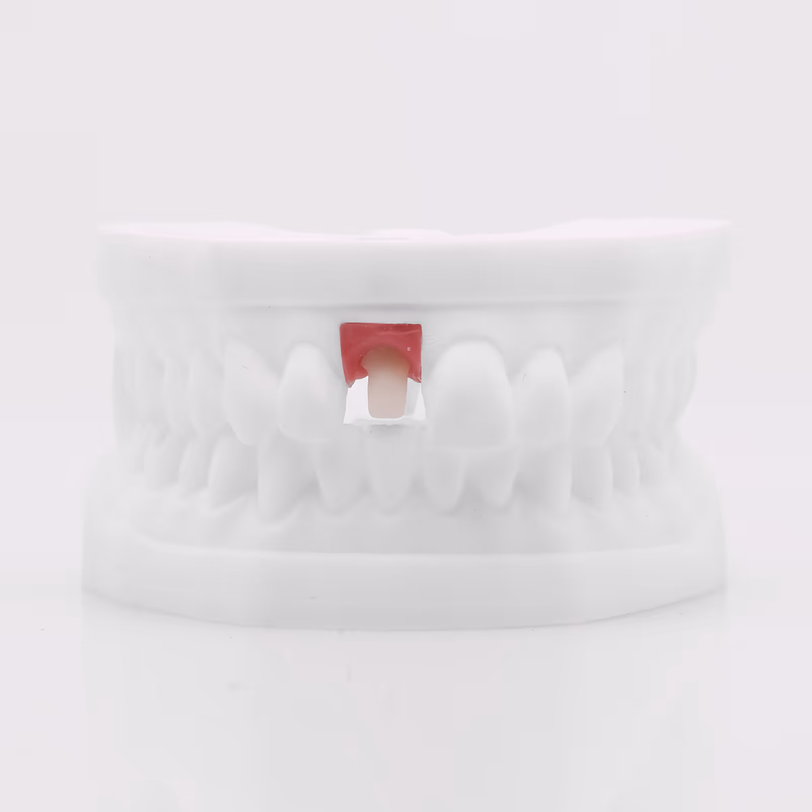 Pilier anatomique usiné E.max Press Ti-Base pour implant esthétique - H32 Dental