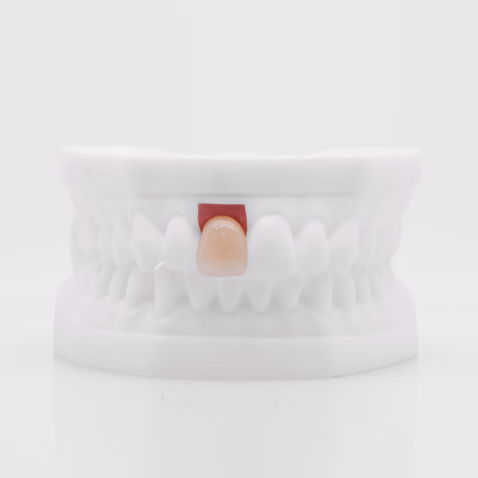 Couronne sur implant scellée céramo-métallique durable - H32 Dental