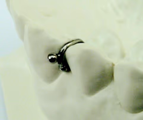 Double ball clasp for enhanced orthodontic appliance stability - H32 Dental