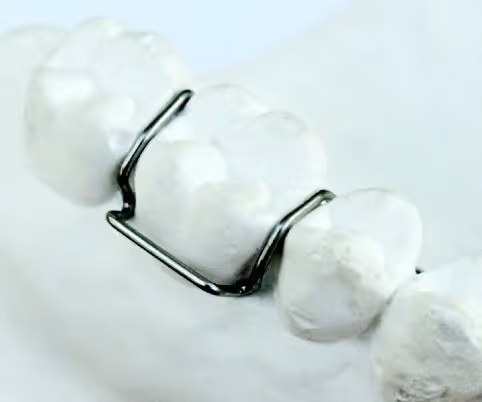 Adams clasp for secure orthodontic appliance retention - H32 Dental