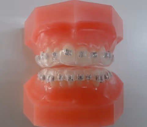 Vestibular indirect bonding system for orthodontic treatment - H32 Dental
