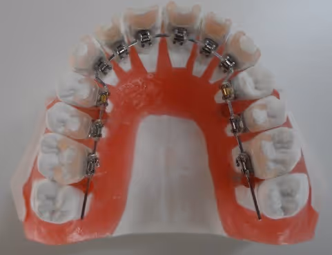 Lingual indirect bonding system for discreet orthodontic treatment - H32 Dental
