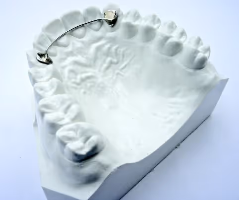 Bonding retainer with metal support for permanent orthodontic retention - H32 Dental