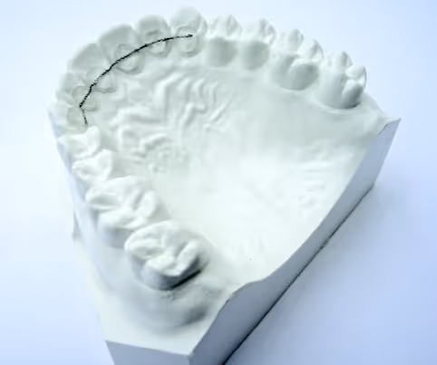 Bonding retainer with resin support for orthodontic retention - H32 Dental