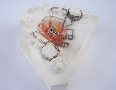 Pendex orthodontic appliance for distalization and expansion - H32 Dental