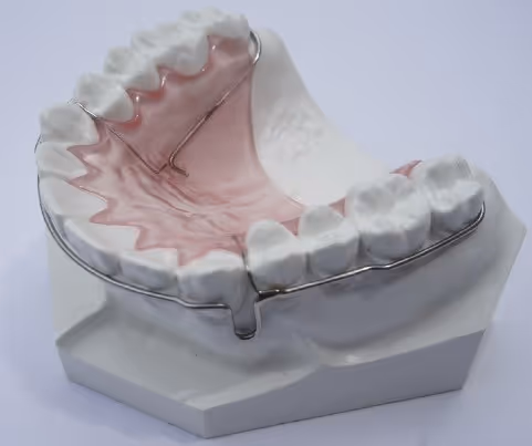Wrap around retainer with connecting wire for maxillary retention - H32 Dental