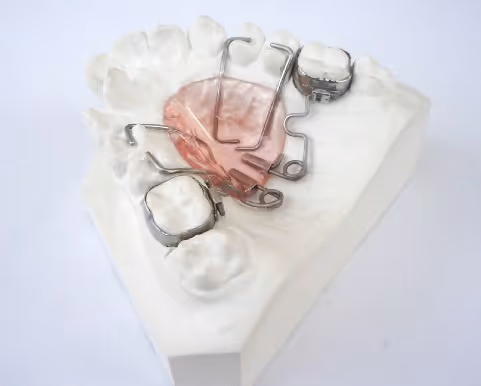 Pendulum orthodontic device for molar distalization - H32 Dental