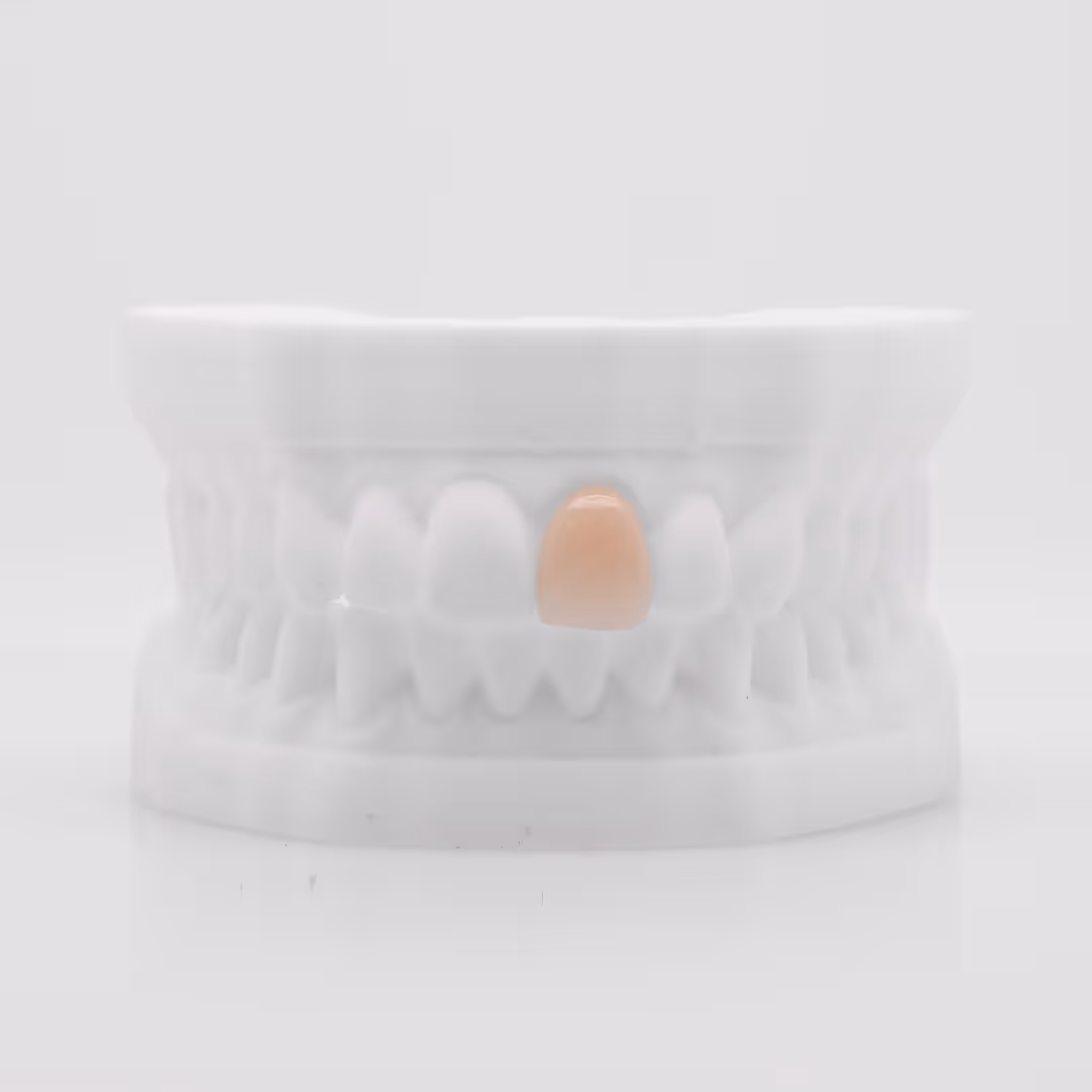 E.max stratified crown for superior aesthetic restoration - H32 Dental