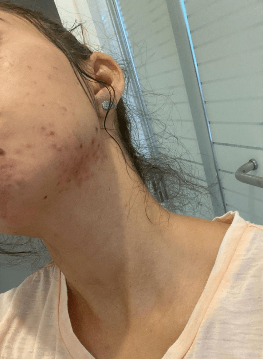 צילום תקריב של פנים עם אקנה דלקתי בלחיים וסנטר, עור אדמומי ומגורה
