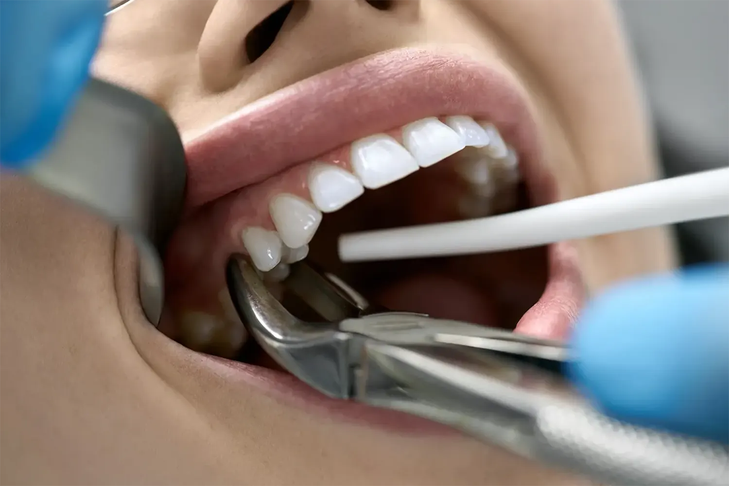Tooth Extractions in Norwalk | Daniel Dental Studio