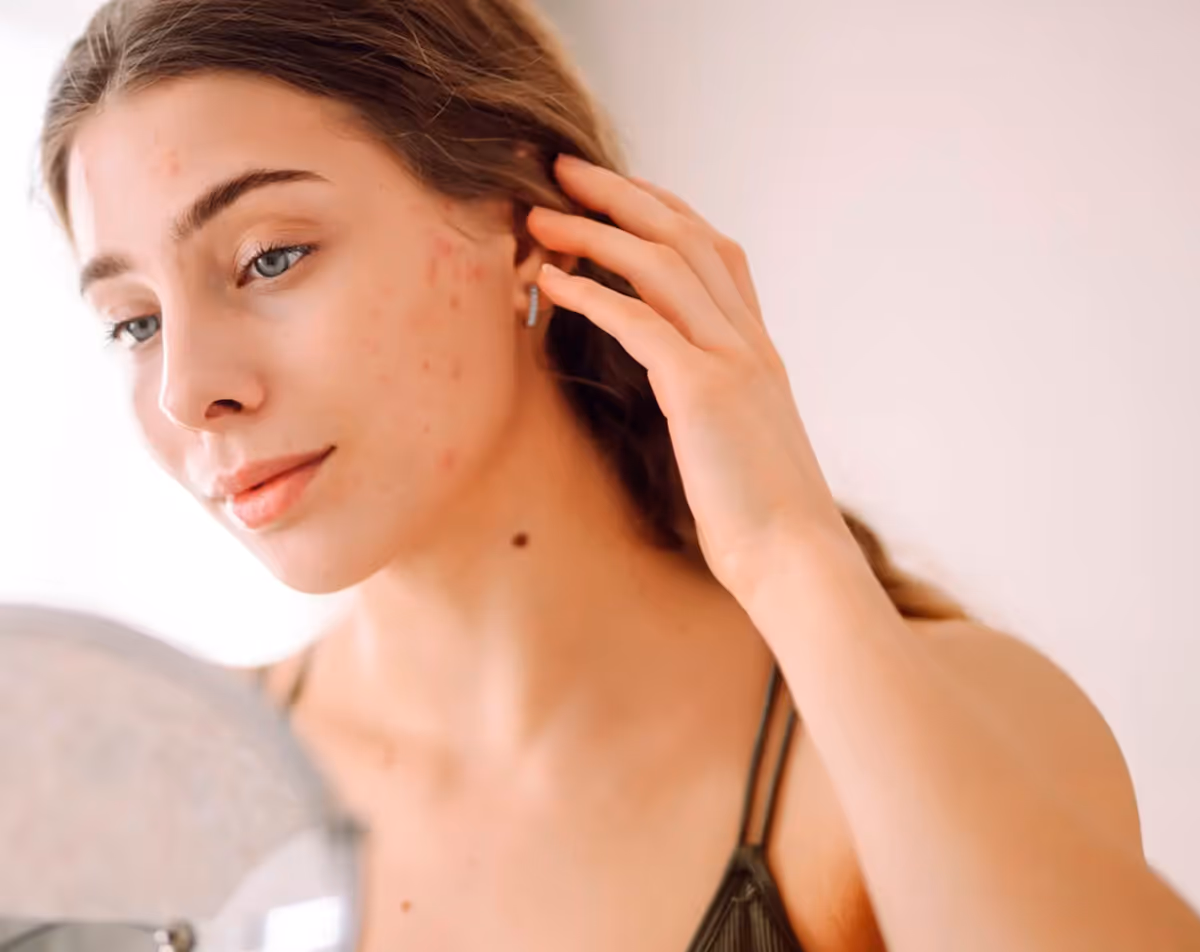 Young woman with mild acne and clear skin tone after acne treatment with Hedfirst.