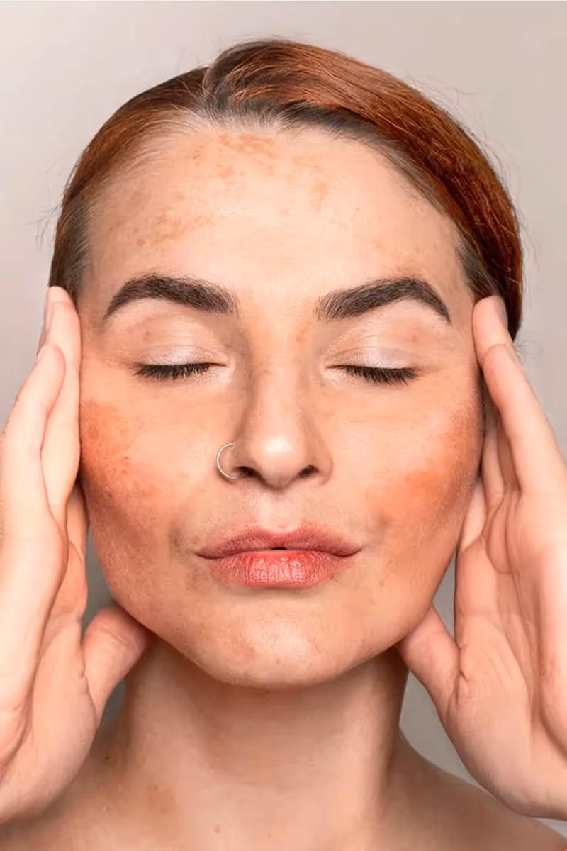 Woman with melasma touching her face before treatment — Hedfirst skincare for dark spots and uneven tone.