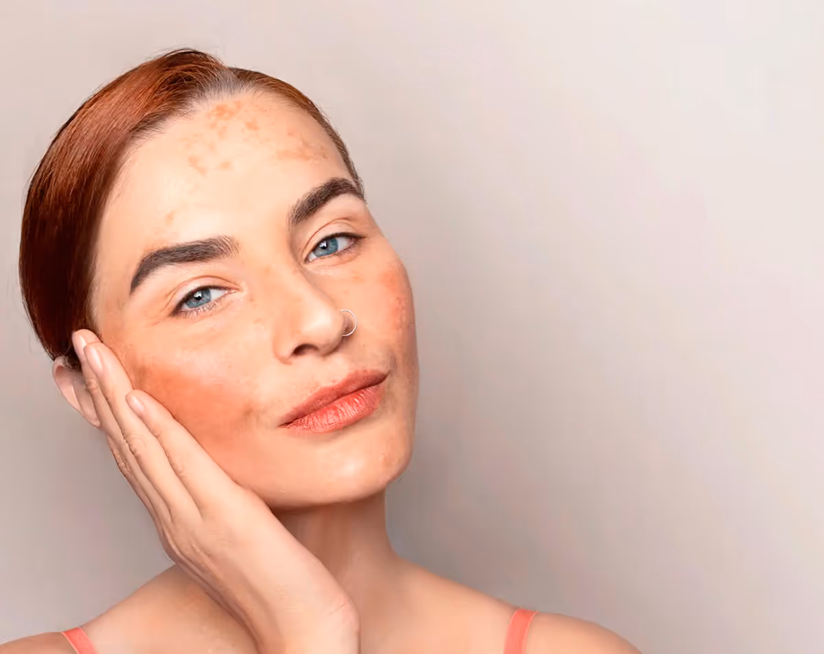 Close-up of woman with melasma after Hedfirst treatment, showing brighter and more even skin tone.