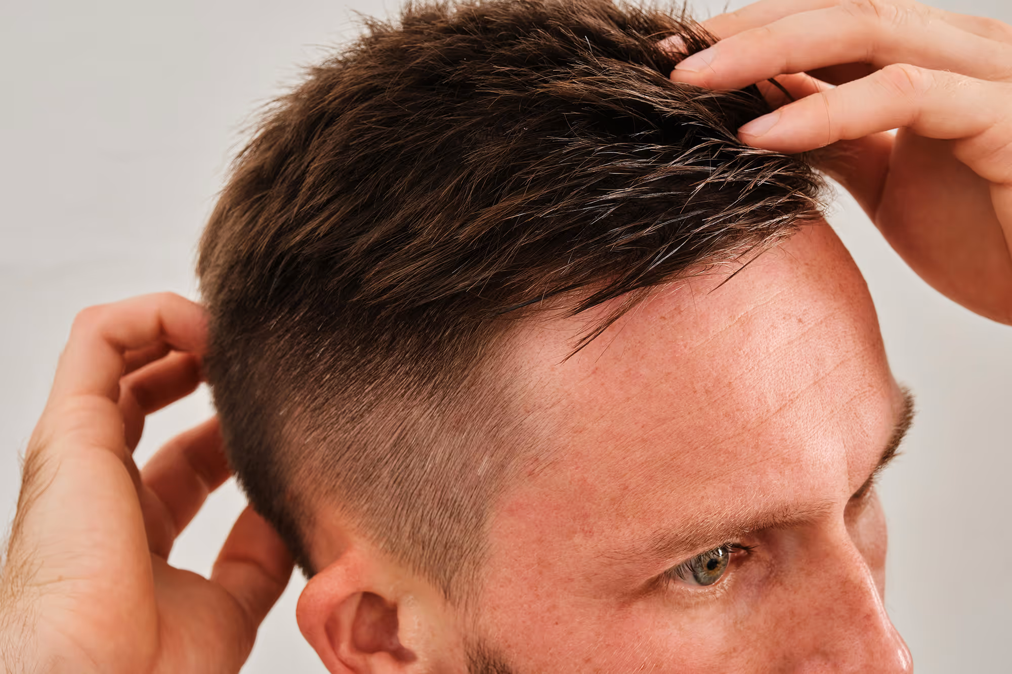 Close-up of healthy hair growth after Hedfirst hair regrowth treatment.