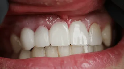 Close-up of upper and lower teeth showing dental implants on the upper front teeth.