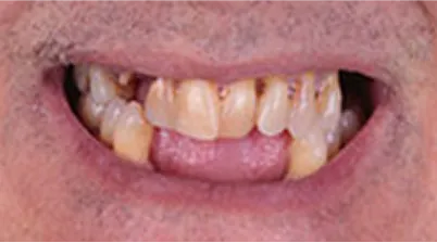 Close-up of a person's mouth showing severely decayed, discolored, and missing teeth.
