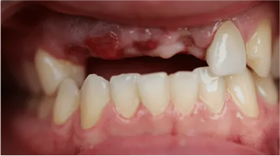 Close-up of a partially edentulous upper jaw showing missing front teeth and the lower teeth intact.