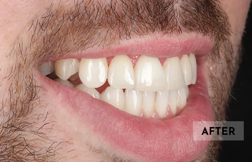 Close-up side view of a man's smile showing clean, aligned teeth after dental treatment.