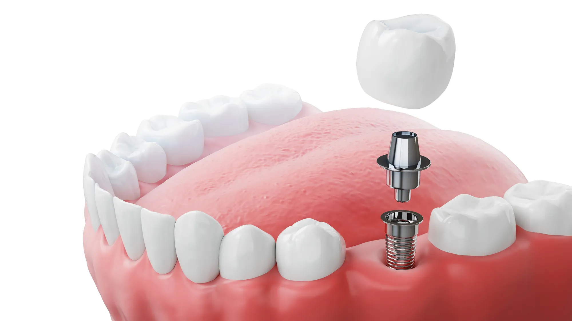 single tooth implant in Fremont