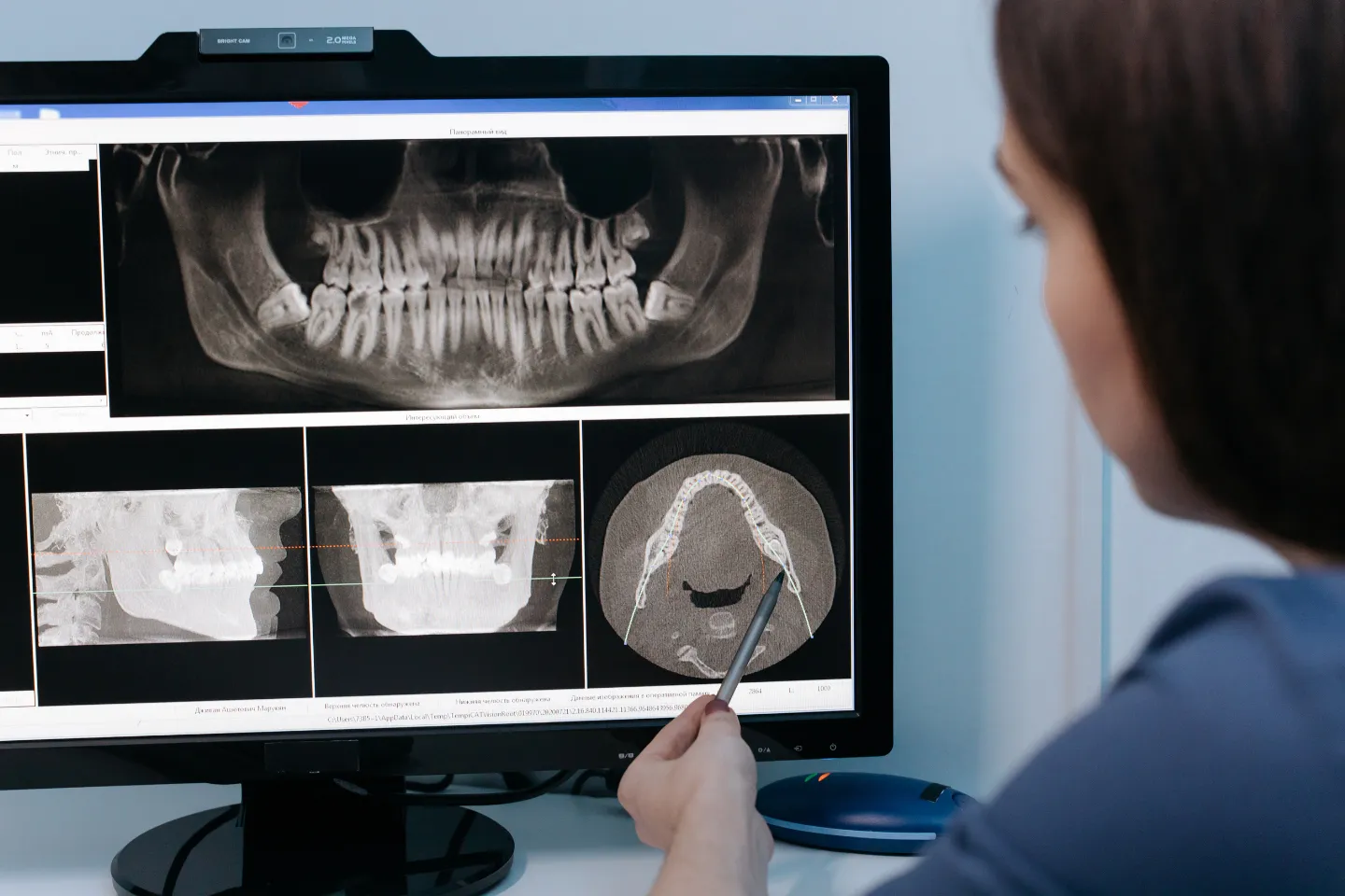 Dentist reviewing 3D cone beam CT scans of the jaw on a monitor