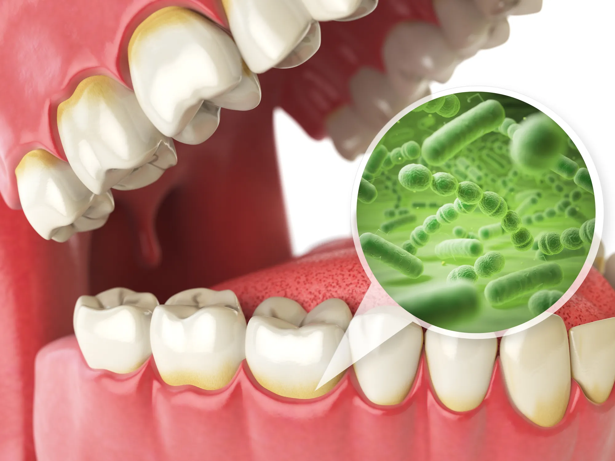 deep cleaning in Fremont, CA - gum disease treatment in Fremont
