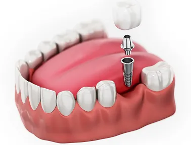 Are Dental Implants Worth the Investment?