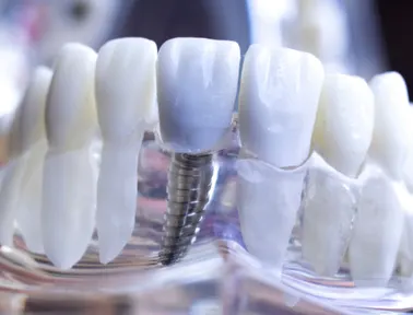 Advantages of Dental Implants: Long-Lasting Solution for Your Smile