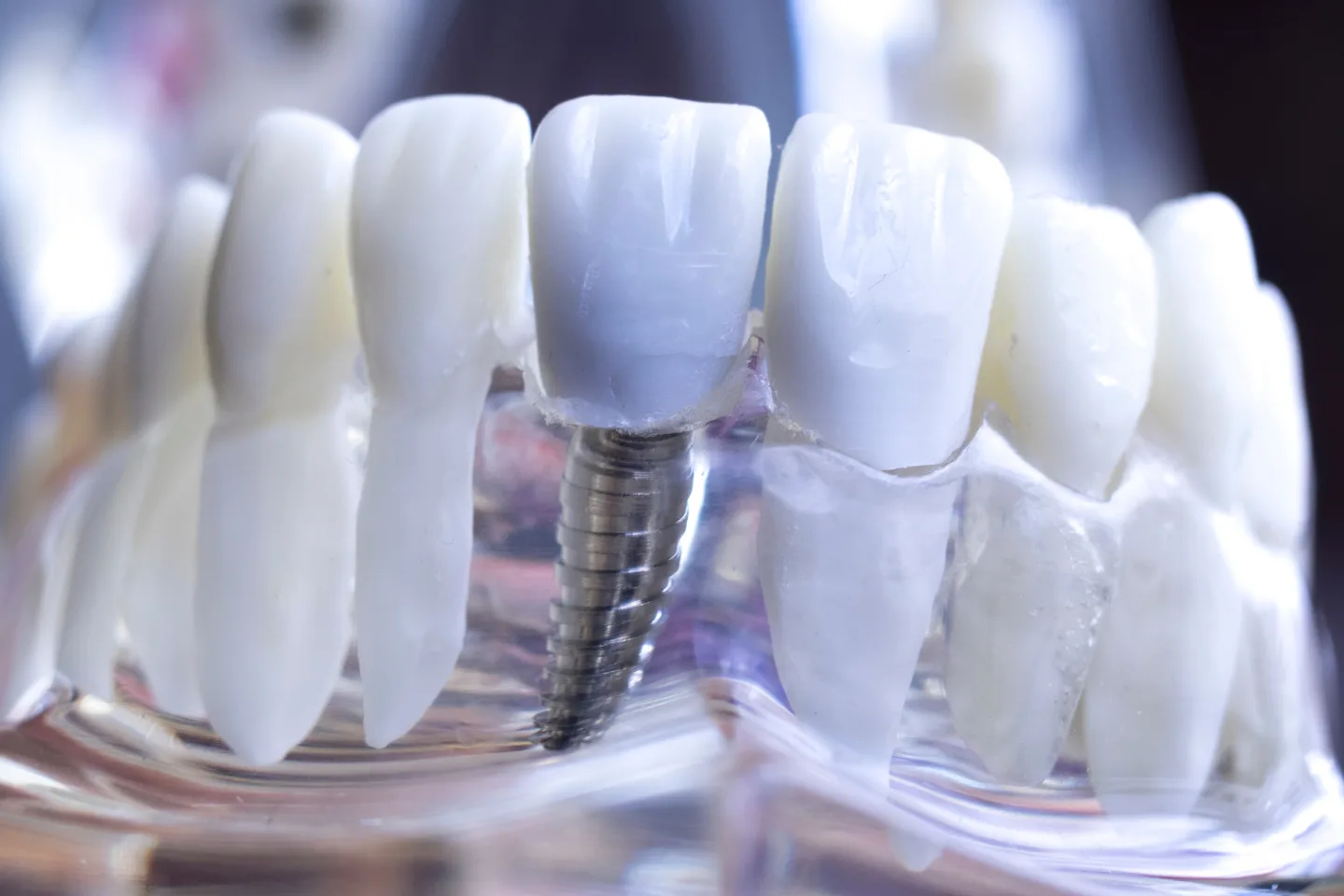 Top Advantages of Dental Implants: The Lasting Smile Solution