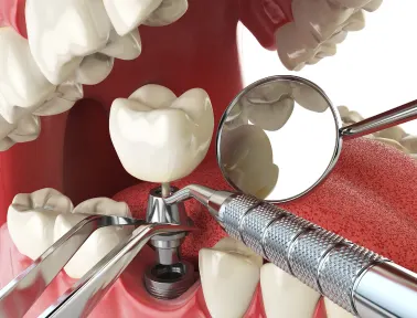 How Long Do Dental Implants Last in Fremont?