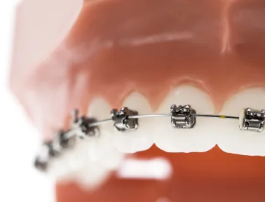 Does Medicaid Cover Orthodontics in Fremont?
