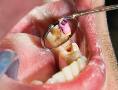 How to Know if You Need a Root Canal Treatment in Fremont