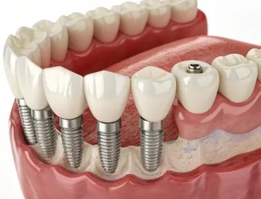 Does Delta Dental Cover Full Mouth Implants in Fremont, CA