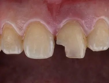 How Do Dentists Fix a Chipped Tooth in Fremont, CA?