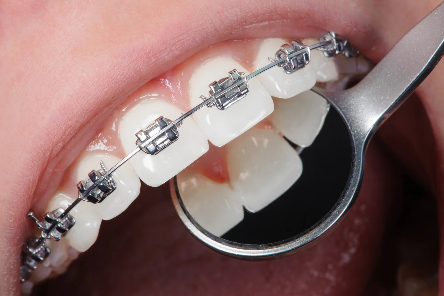 Does Delta Dental Cover Orthodontics in Fremont, CA?